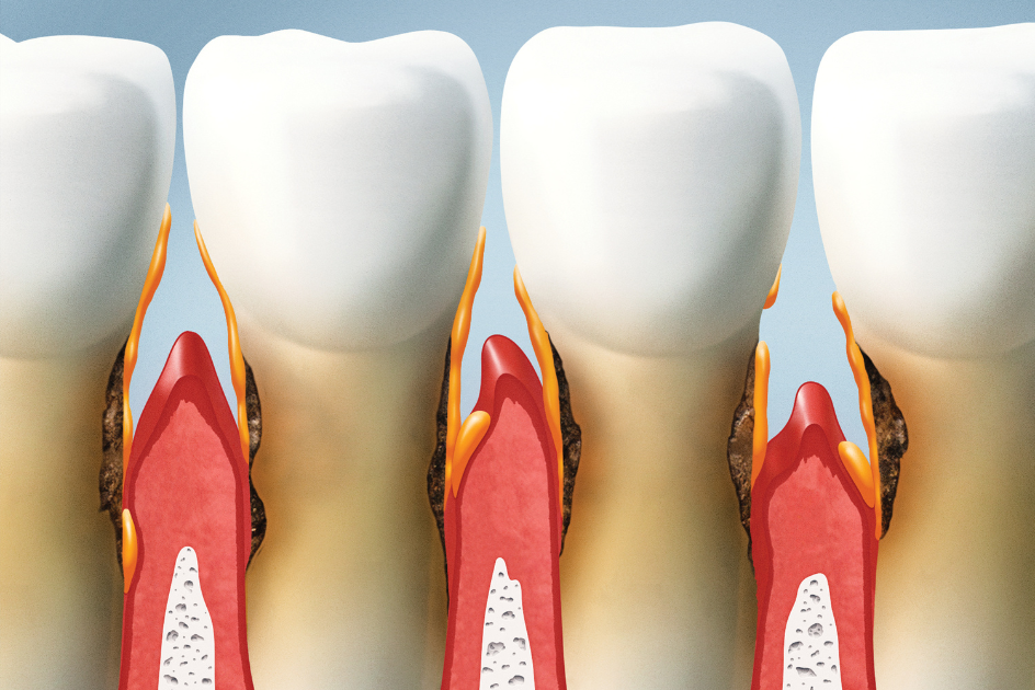 in between gums